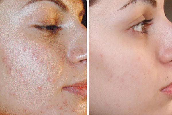 Microneedling: ¿Qué Es y Para Qué Sirve