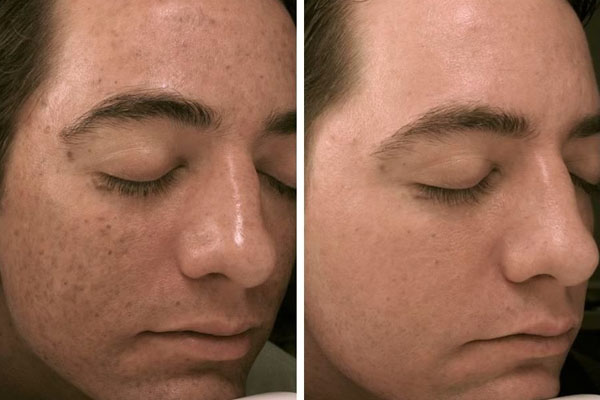 microneedling