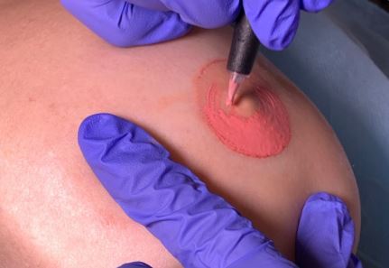 ¿Qué es la Micropigmentación Paramédica de Areolas?