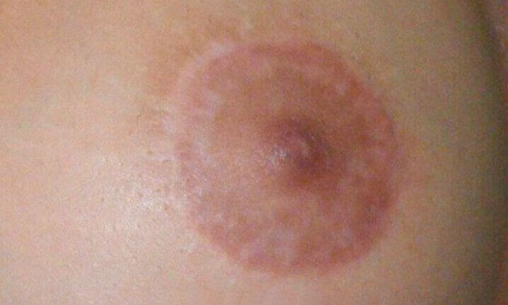 ¿Qué es la Micropigmentación Paramédica de Areolas?