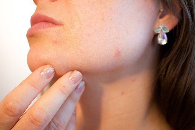 Microneedling: ¿Qué Es y Para Qué Sirve